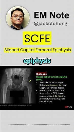 Slipped capital femoral epiphysis (SCFE)