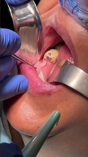 How Are Dental Implants Attached to the Gums?