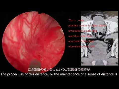 【医師向け】ホルミニウムレーザー前立腺核出術（HoLEP）解説動画