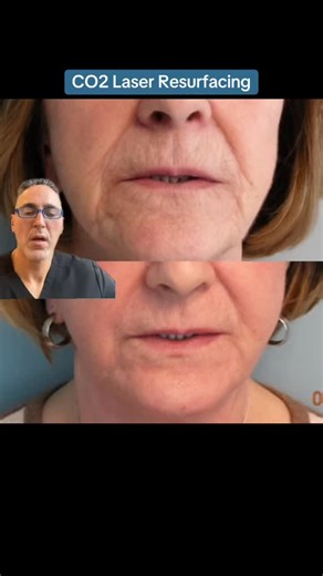 13K views · 105 reactions | CO2 Laser Resurfacing The only laser...