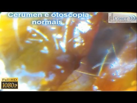 Cerumen e Otoscopia normais FULL HD \\Normal earwax and otoscopy HD 1080p