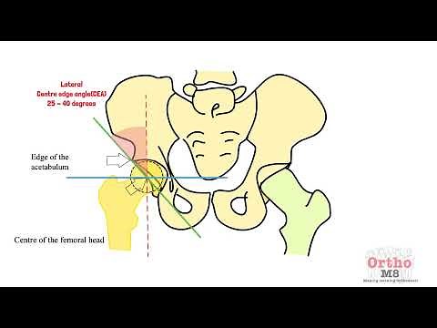 Lateral Centre edge angle