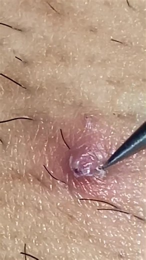Ingrown Hair Relief Techniques and Tips