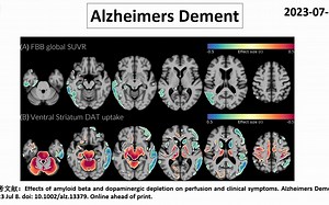 Alzheimers Dement—Aβ和纹状体DAT摄取对脑灌注和临床症状具有不同的作用
