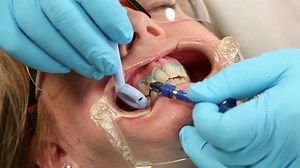 Opalustre Kit - Optident - Specialist Dental Products And Courses