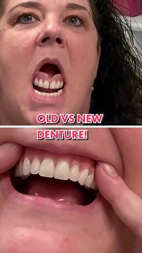 We replaced our patient’s old denture with a brand new sunction denture. Just look at the difference! #denture #dentures #newdentures #loosedentures #dental