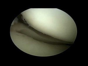 Partial ACL Tear Diagnostic Knee Arthroscopy