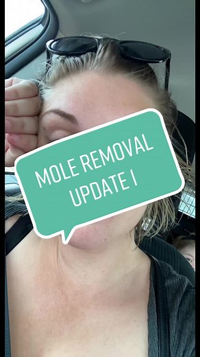 2 Days Post Mole Removal Procedure Update
