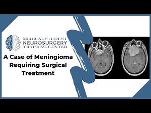 A Case of Meningioma Requiring Surgical Treatment