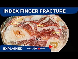 Index Finger Fracture