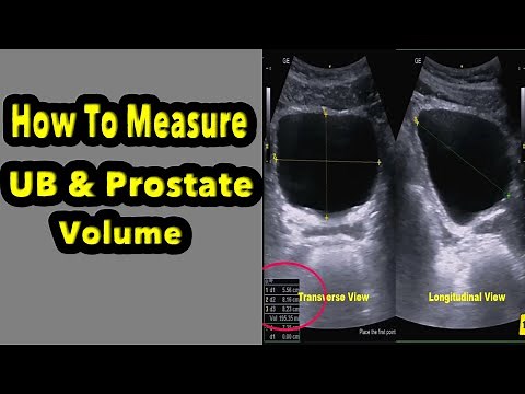 How to Measure Urinary Bladder and Prostate Volume (Demo For Residents)
