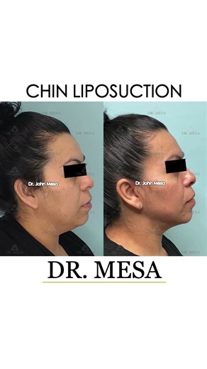 Before and After #ChinLipo #chinliposuction #plasticsurgery #nyc