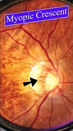 Myopic Crescent | Smartphone Fundus Videography | Fundus Photography | Short Video 513