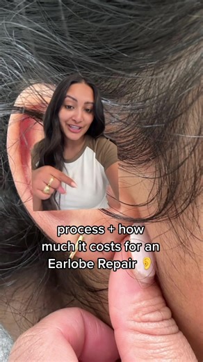here is the whole process of my earlobe repair how much it costs!👂 I got the procedure done in Austin by @drvictoriagivens and she did an incredible job! SO happy with my results! Counting down to the day that I can wear my chunky hoops again🥰🫶 #earloberepair #earloberepairing #rippedearlobe