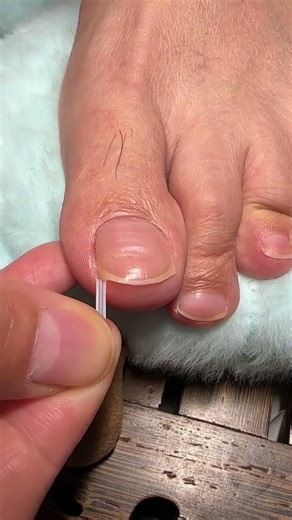 Foot care #toe splitter #toe overlap 1011ukjhgf097b