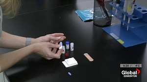 HIV & syphilis rapid test approved in Canada, thanks to Alberta research
