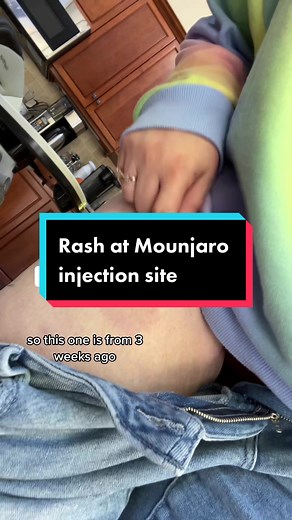 Dealing with Mounjaro Injection Site Reactions: My Journey