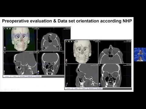How to use Computer Assisted Surgery (CAS) for Primary & Secondary Orbital Reconstruction (snippet)