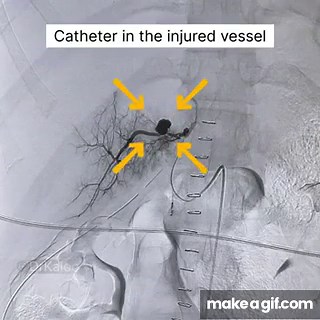 Embolisation for bleeding vessel in the Liver. on Make a GIF