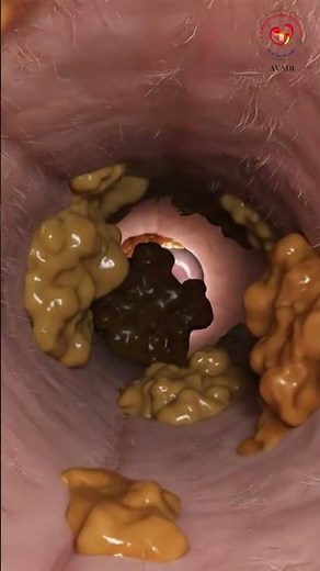 👂 Is Ear Wax Causing Your Hearing Problems? | Safe Removal & What NOT to Do