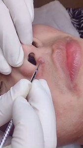 MỤN NANG LÀ GÌ? NGUYÊN NHÂN HÌNH THÀNH MỤN NANG Mụn nang được biết đến là loại mụn khá nguy hiểm cho làn da, bởi nó là những túi mụn ăn sâu dưới da, có chứa nhiều mủ dịch và gây đau nhức, sưng viêm, …. Trong 1 số trường hợp nặng hơn có thể gây hại cho cơ thể, vậy nên mụn nang là mụn cần được điều trị ngay khi có dấu hiệu phát triển. MỤN NANG LÀ GÌ? Mụn nang xuất phát cũng là 1 loại biến thể khác của mụn trứng cá, nó ở tình trạng “tồi tệ” nhất trong tất các các loại mụn trứng cá. Mụn nang có hình