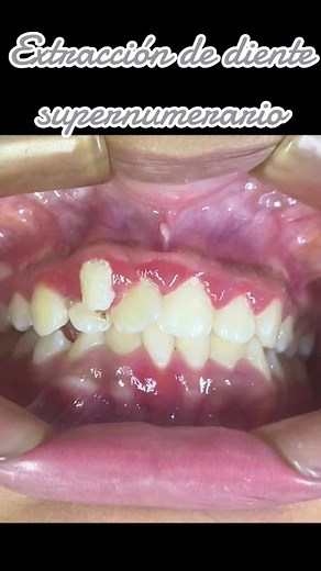 Extracción de diente supernumerario #clinicaendodontics #cirugiadental #dientesupernumerario #anestesiadigitalsindolor