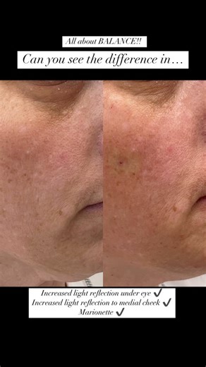 Brittany White RN- BSN on Instagram: "💫 Mid-Low Facial Balancing #dermalfillers #rha #rhacollection #versa #versafiller #revance #revanceaesthetics #revanesse #revanesseversa #facialbalancing 💫 Message me for more details 📅 Book your appointment now! 🛜 www.vitalitymedclinic.com 📞 940-273-5700 ⏰ 1-2 hour session 💰 Depending on needs $700-$4k @vitalitymedicalclinic @britvitalitymedclinic"