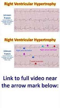 Right Ventricular Hypertrophy