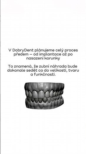 Proč je dobré udělat zubní korunku? | Klinika v Praze 🦷