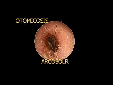 OTOMICOSIS (Infección del conducto auditivo externo por hogos)