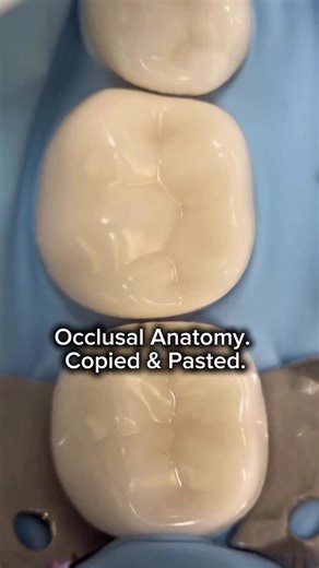 🦷 Anna Papian | Foreign-trained, U.S. approved. USC DDS/DMD ’27. on Instagram: "🦷 Occlusal Stamp Technique (Putty Index with Flowable Composite) This technique allows you to copy the patient’s original molar anatomy before preparation and transfer it back at the final stage of the restoration — instead of recreating occlusal anatomy from scratch. What it’s for: To achieve accurate cusps, slopes, and occlusal contacts quickly and predictably during posterior composite restorations. How it’s mad