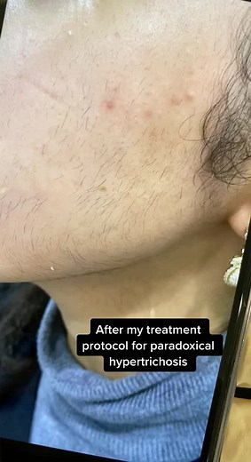 Effective Hair Laser Removal Treatment for Paradoxical Hypertrichosis