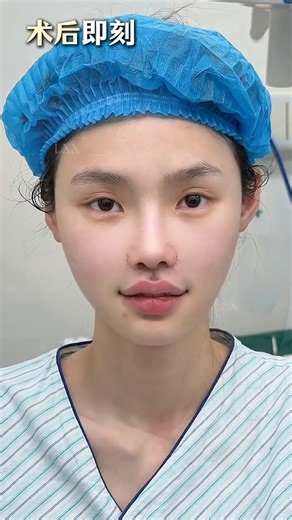 Dr.Jia on Instagram: "Deepening of the midline and adjustment of the mouth circumference#beautiful #plastic #lips #philtrum"