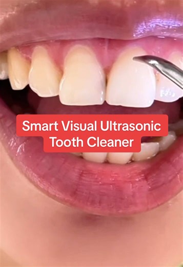 The Benefits of Smart Visual Ultrasonic Tooth Cleaners