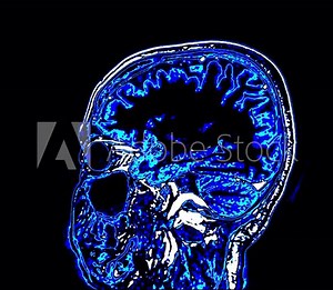 MRI brain perfusion scan highlights a lesion in the left hemisphere, offering detailed insights into blood flow and brain function. Essential for accurate diagnosis and treatment planning.