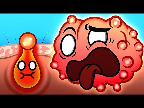 How to get rid of Acne!