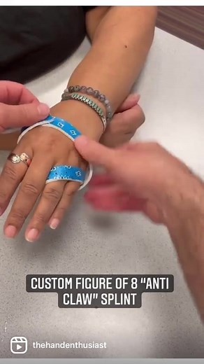 Custom Anti Claw Figure of 8 Splint for Hand Therapy