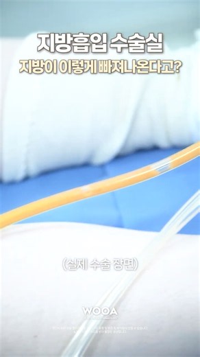 지방흡입 잘되면 지방 이렇게 나옵니다