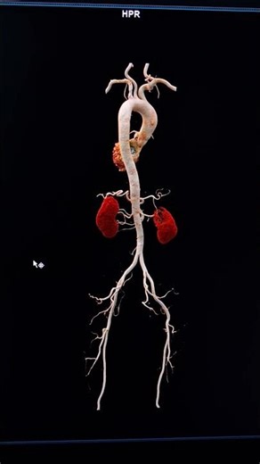 “Complete Aorta VRT CT Scan | 3D Visualization Explained 🔥” #anatomy #ctscan #science #neet #nexfx10