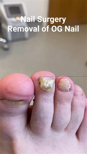 Painful or ingrowing toenails can be removed under minor surgery using local anaesthetic Recovery times are typically between 4-8 weeks depending on the type of nail surgery performed. Be summer ready Talk to us today or book online (01274) 296092 #Podiatry #feet #Bradfordpodiatrist #infectedtoenail #nailsurgery