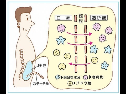 看護学生講座 197 透析 ｢腹膜透析の原理、方法、注意点｣