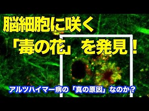 アルツハイマー病の真の原因を発見か？ Discovered the true cause of Alzheimer's disease?