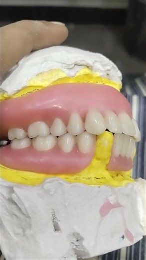 Teeth Arrangement Of Upper Complete Lower Removable Partial Soft Lining Denture 😁😁😁#softdenture