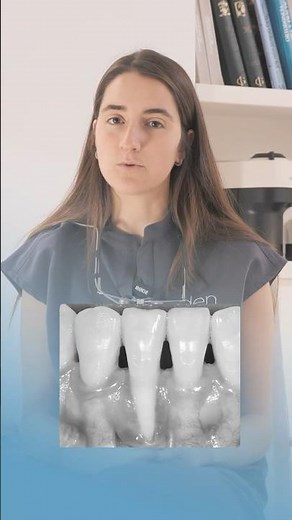 RECESIÓN GINGIVAL ➡️ las 5 RAZONES PRINCIPALES ✅ y el riesgo de PERIODONTITIS
