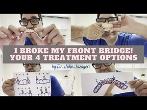 I Broke My Front Bridge: New Bridge vs Partial Denture vs Dental Implants vs All-on-4