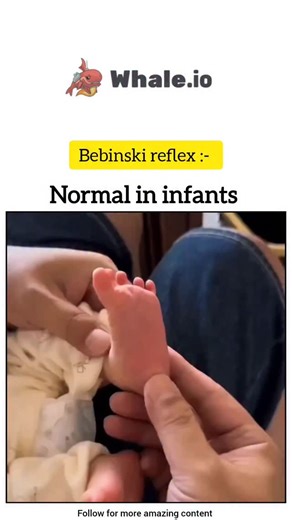 Ak Nursing Academy on Instagram: "The Babinski reflex (or sign) is a neurological response where stroking the sole of the foot causes the big toe to extend upward and the other toes to fan out, which is normal in infants but indicates potential Central Nervous System (CNS) damage (like spinal cord or brain issues) in adults and older children, signaling a problem with the corticospinal tract. It's elicited by a doctor using a blunt object and is crucial in neurological exams to check for conditi