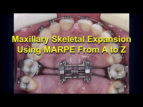 Maxillary Skeletal Expansion using MARPE from A to Z (Updated)