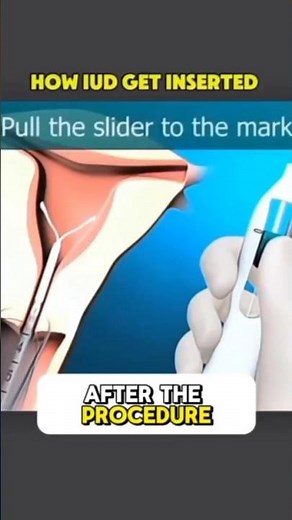 You Won’t Believe How Simple This Birth Control Procedure Is!