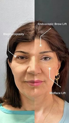 Upper & Lower Blepharoplasty + Endoscopic Brow Lift + Midface Lift (Combination Procedures)
