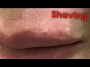 SHOCKING causes of BLACKHEADS on the LIP AREA